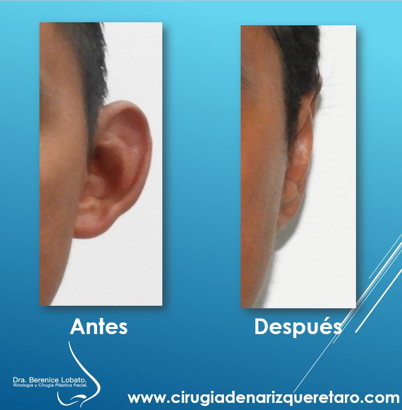 otoplastia en hombre resultados detras