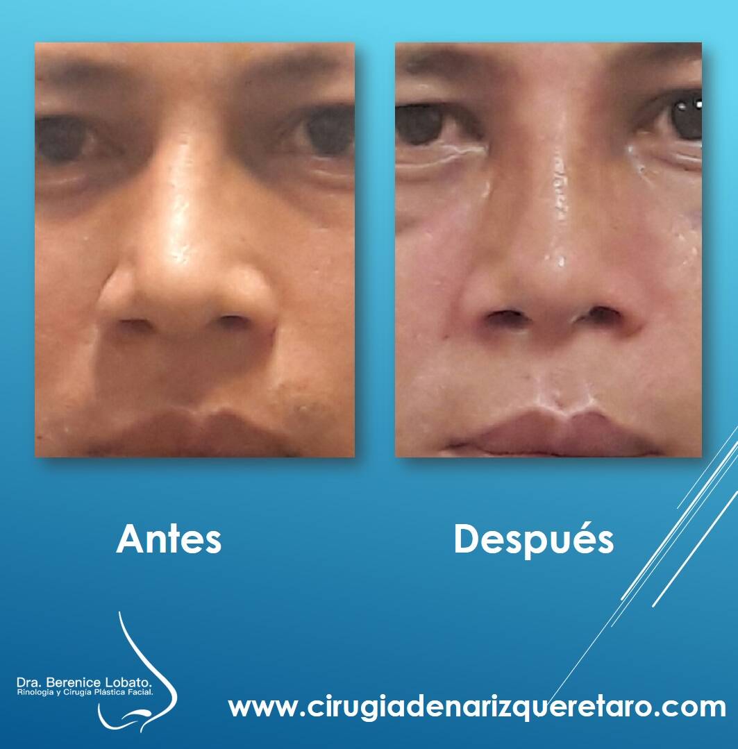  rinoplastia resultados nariz torcida
